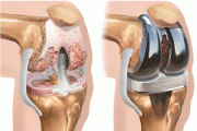 Photo 1: Joint replacement implants improve the quality of life for millions of people around the world