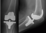 Photo 2: The fit between the femoral knee component and the tibia plate must be just right – not too tight and not too loose!